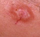 Basal Cell Carcinoma